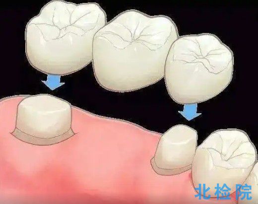 修復用人工牙測試